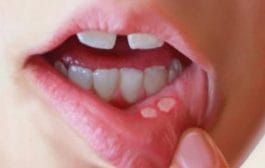 आरोग्य टिप्स । उन्हाळ्यात तोंड येत आहे? मग 'हे' तीन उपाय करा