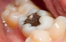 दातांमध्ये कीड लागली... तर हे घरगुती उपाय करा