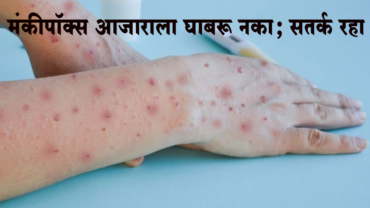मंकीपॉक्स आजाराला घाबरू नका; सतर्क रहा, आरोग्य विभागाकडून सूचना जारी