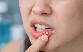 तोंड येणे म्हणजे काय? दुर्लक्ष केल्यास वाढू शकतो धोका